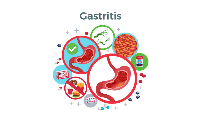 不健康食物导致的胃炎疾病和受影响的胃细菌食物矢量图