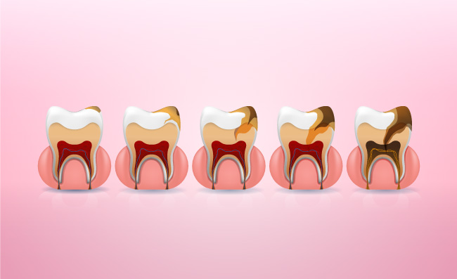现实龋齿结构污渍牙釉质龋小牙牙髓炎牙周炎矢量图