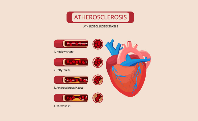 心脏人类心血管系统的插图胆固醇动脉动脉粥样硬化阶段心脏中风血栓攻击血液循环系统矢量医疗图表