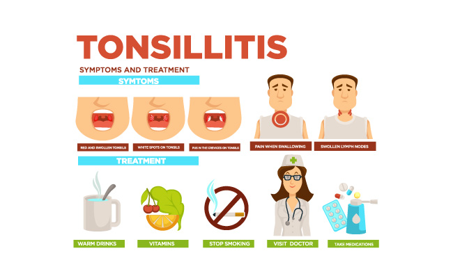 咽喉疾病扁桃体炎症状治疗药物图片